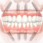 implant denture statistics