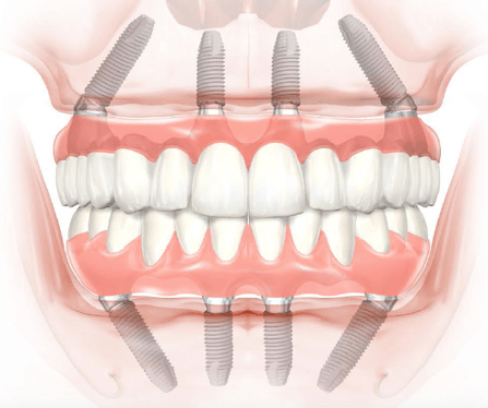 implant denture statistics